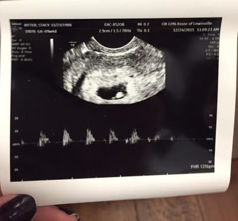 Ultrasound